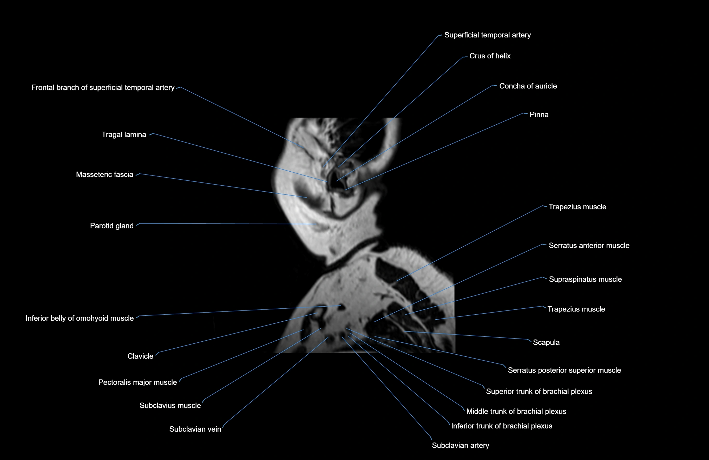 Neck MRI sagittal cross sectional anatomy 3D 1mm 3T radiology  image-img-00001-00041.webp